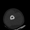 SPORK, NICO - 22.03.1976 - 02.08.2022 - CT obere Extremität - 17:51:17
